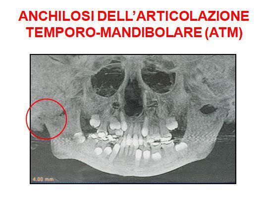 en-ANCHILOSI :: maxfax-francocarlino